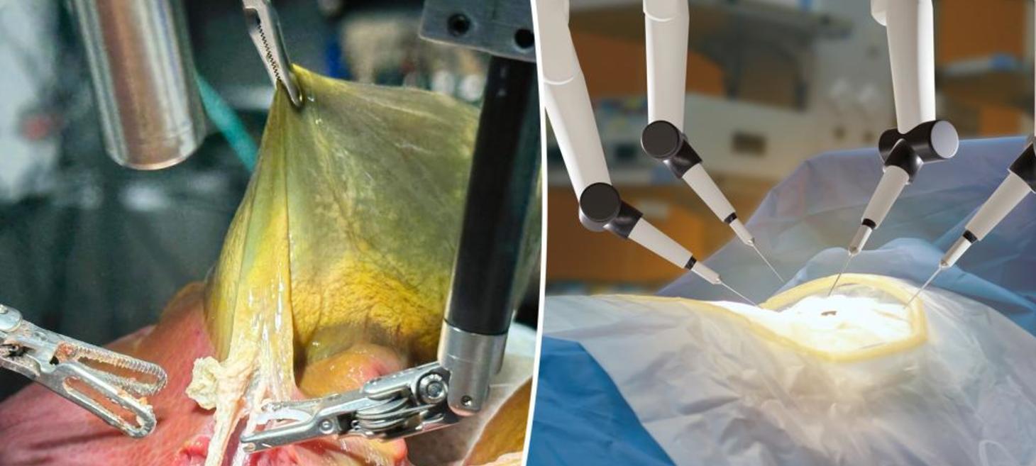 AI-trained robot completes groundbreaking gall bladder operation with 100% success: ‘The future is bright’