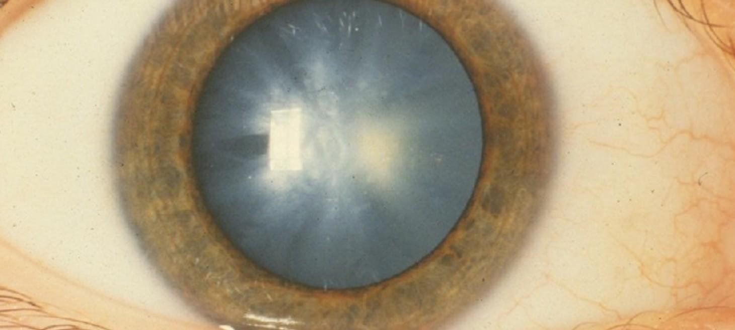 This AI Can Diagnose a Rare Eye Condition as Well as a Human Doctor