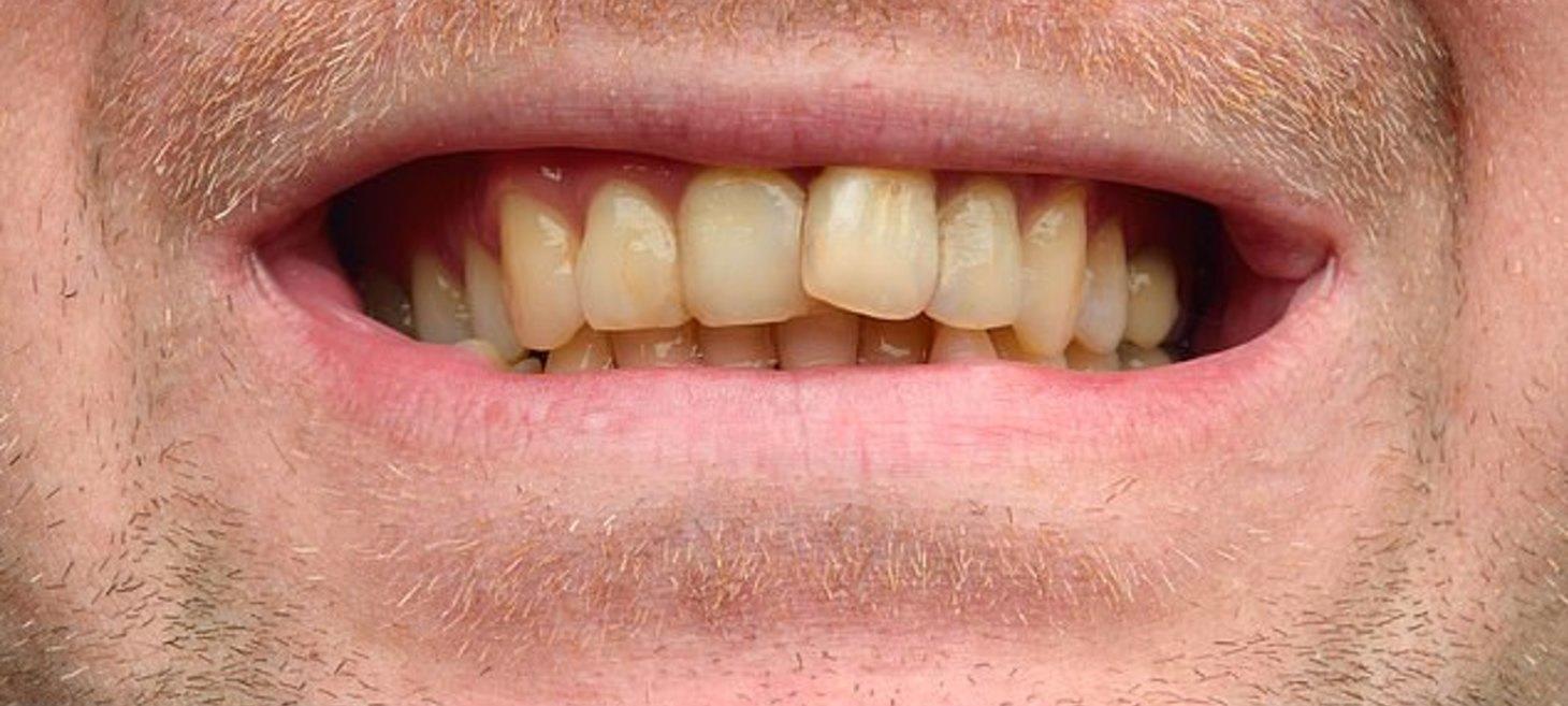 Research reveals Americans think British people have bad teeth and Australians think we're ugly